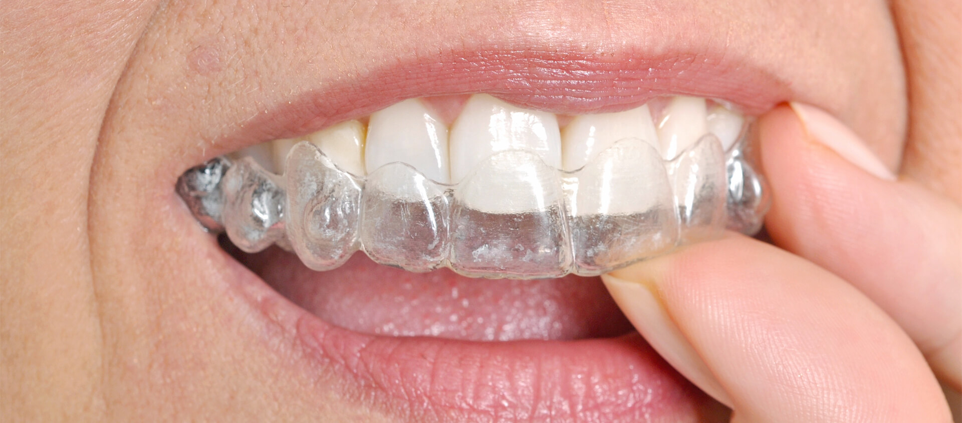 Invisalign Orthodontics Brandon FL - Invisible Teeth Straightening