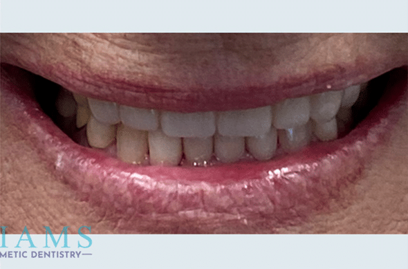 aesthetic-crowns-6-11-and-22-27A aesthetic-crowns-6-11-and-22-27A