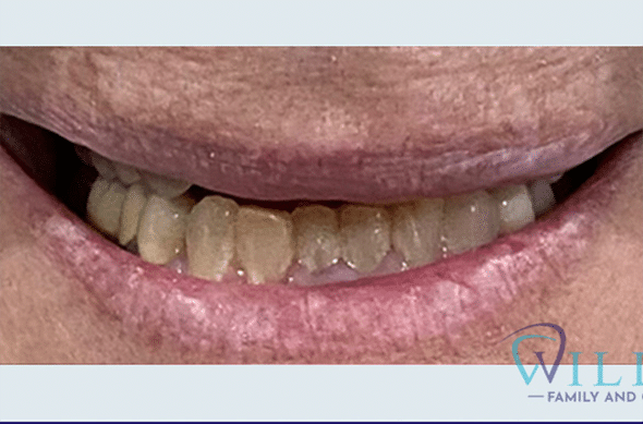 aesthetic-crowns-6-11-and-22-27B aesthetic-crowns-6-11-and-22-27B