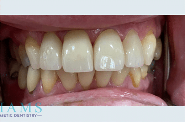 aesthetic-crowns-7-10A aesthetic-crowns-7-10A