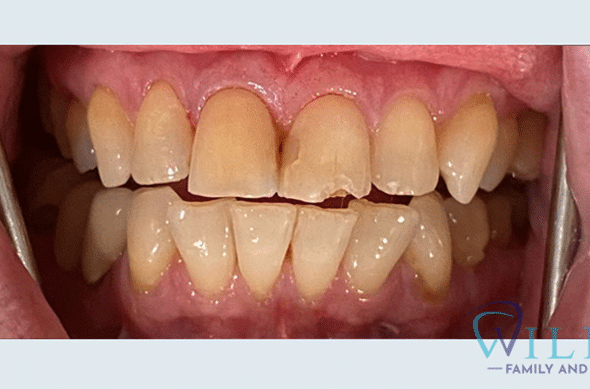 aesthetic-crowns-7-10B aesthetic-crowns-7-10B