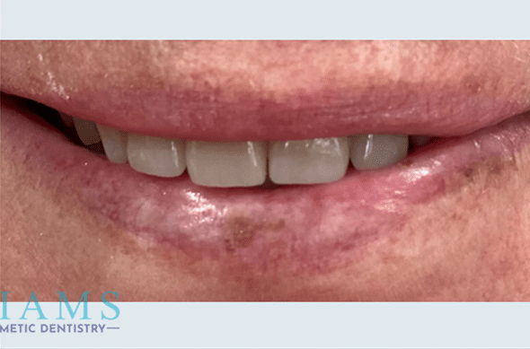 anterior-crowns-7-10A anterior-crowns-7-10A