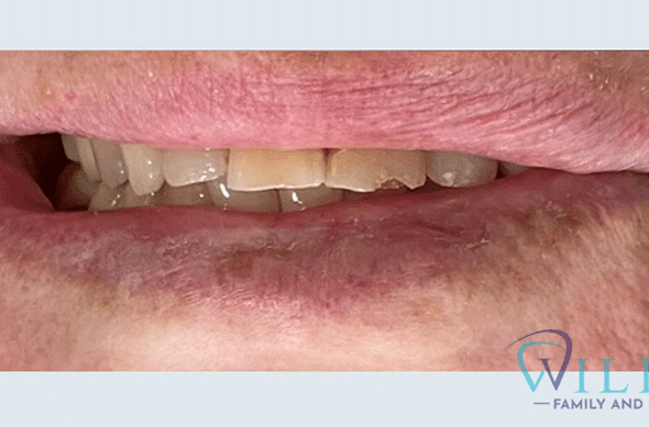 anterior-crowns-7-10B anterior-crowns-7-10B