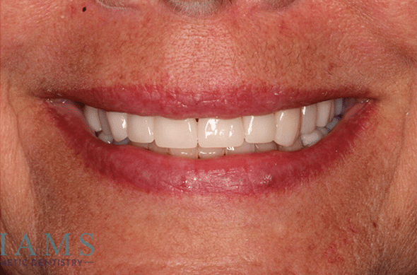 crowns-ba-1-1A crowns-ba-1-1A