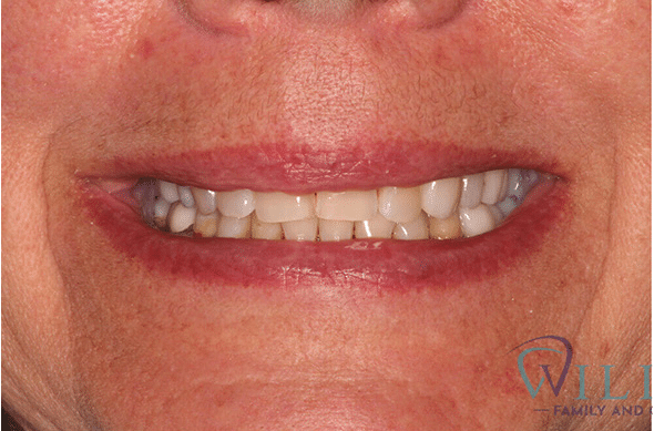 crowns-ba-1-1B crowns-ba-1-1B