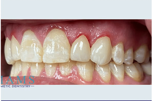 esthetic-crowns-bna3-1-a esthetic-crowns-bna3-1-a