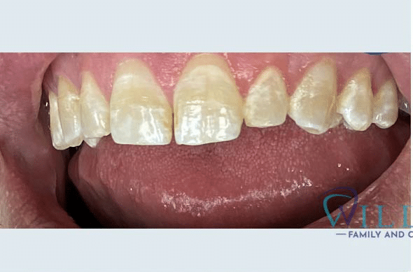 esthetic-crowns-bna3-1-b esthetic-crowns-bna3-1-b