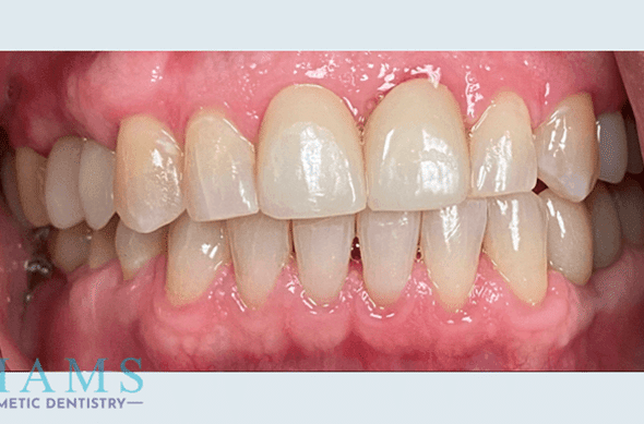 full-mouth-rehabilitation-to-restore-functionA full-mouth-rehabilitation-to-restore-functionA