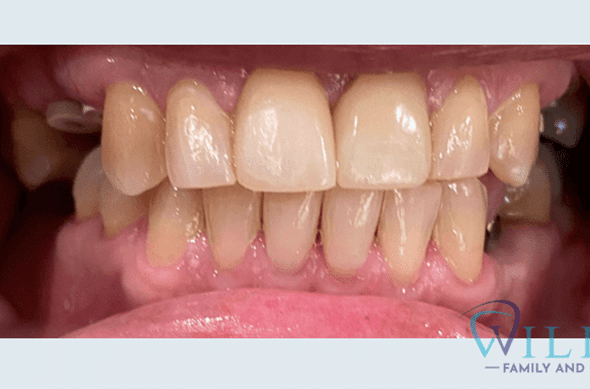 full-mouth-rehabilitation-to-restore-functionB full-mouth-rehabilitation-to-restore-functionB