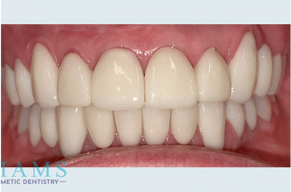 full-mouth-restoration-and-crowns-bnaA full-mouth-restoration-and-crowns-bnaA