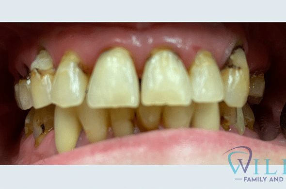 full-mouth-restoration-and-crowns-bnaB full-mouth-restoration-and-crowns-bnaB