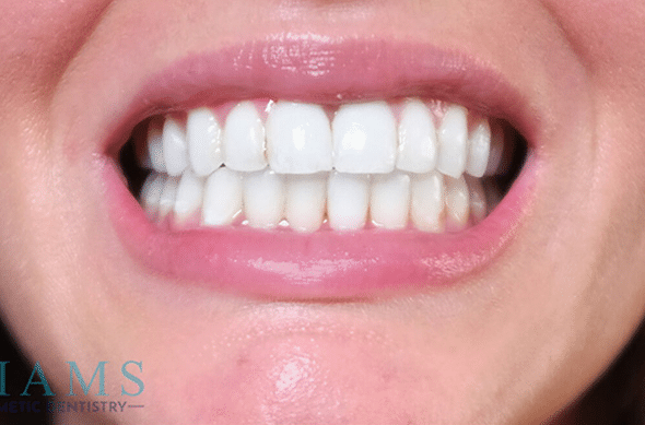 invisalign-ba-1-t4-1A-1 invisalign-ba-1-t4-1A-1