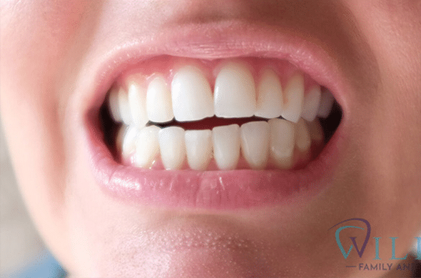 invisalign-ba-1-t4-1B-1 invisalign-ba-1-t4-1B-1