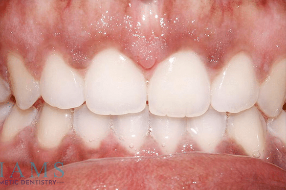 invisalign-ba-2-1A invisalign-ba-2-1A