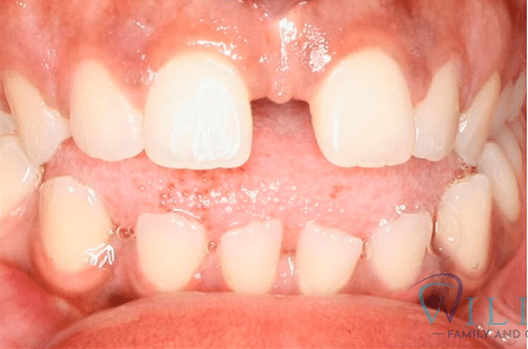 invisalign-ba-2-1B invisalign-ba-2-1B