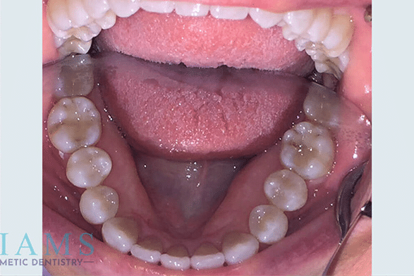 invisalign-ba-3-1A invisalign-ba-3-1A