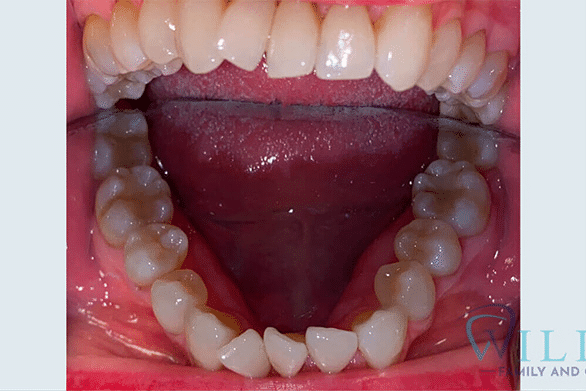 invisalign-ba-3-1B invisalign-ba-3-1B