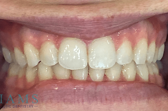 invisalign-ba-4-1A invisalign-ba-4-1A