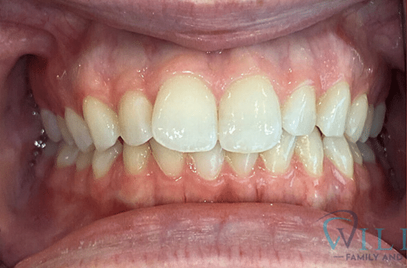 invisalign-ba-4-1B invisalign-ba-4-1B