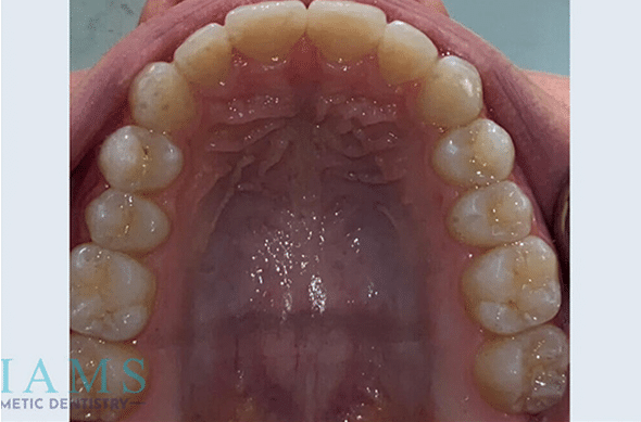 invisalign-ba-5-1A invisalign-ba-5-1A