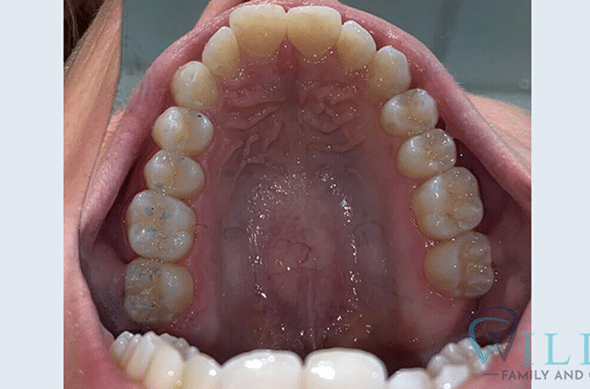 invisalign-ba-5-1B invisalign-ba-5-1B