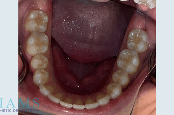 invisalign-ba-6-1A invisalign-ba-6-1A