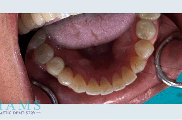 mandibular-implant-crowns-to-restore-function-bna-1A mandibular-implant-crowns-to-restore-function-bna-1A