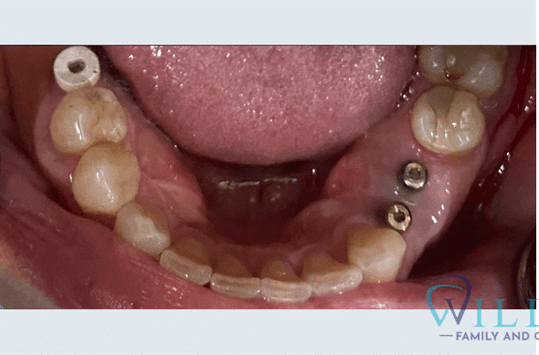 mandibular-implant-crowns-to-restore-function-bna-1B mandibular-implant-crowns-to-restore-function-bna-1B