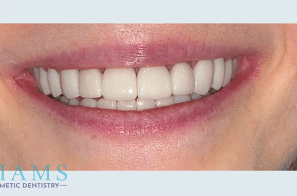 maxillary-and-mandibular-crowns-bnaA maxillary-and-mandibular-crowns-bnaA