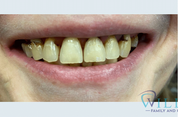 maxillary-and-mandibular-crowns-bnaB maxillary-and-mandibular-crowns-bnaB