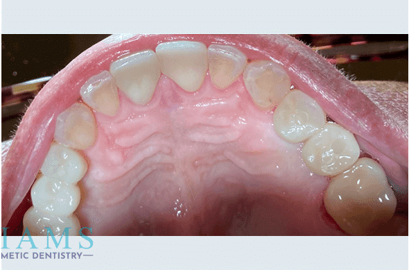 maxillary-implant-crowns-to-restore-function-bna-2-1A maxillary-implant-crowns-to-restore-function-bna-2-1A