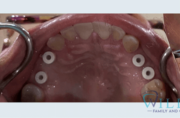 maxillary-implant-crowns-to-restore-function-bna-2-1B maxillary-implant-crowns-to-restore-function-bna-2-1B
