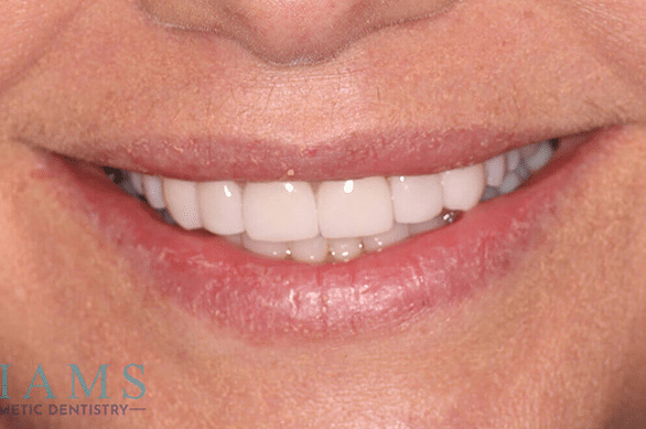 veneers-ba-1A veneers-ba-1A