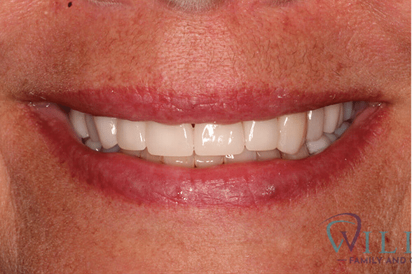 veneers-ba-1B veneers-ba-1B